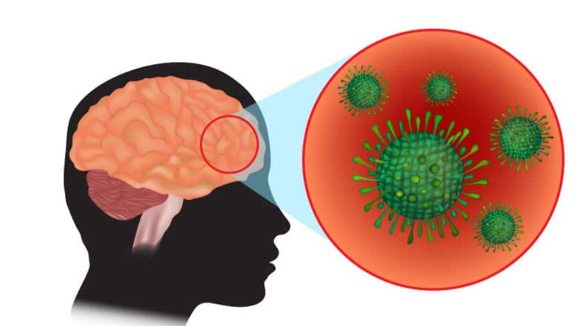 মেনিনজাইটিস কেন হয় জানেন? ঝুঁকিতে কারা