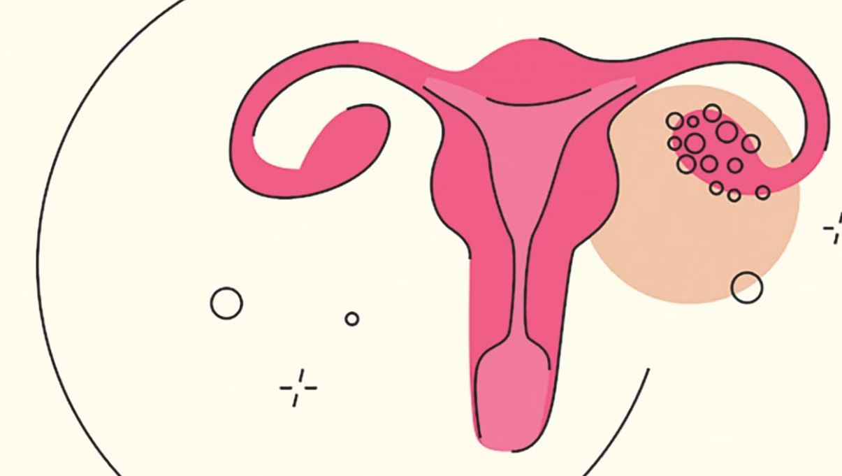 পলিসিস্টিক ওভারিয়ান সিনড্রোম ও বন্ধ্যাত্ব