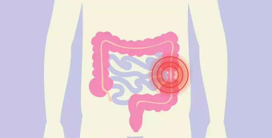 আইবিএস কী ও কেন হয়, কোন লক্ষণে বুঝবেন