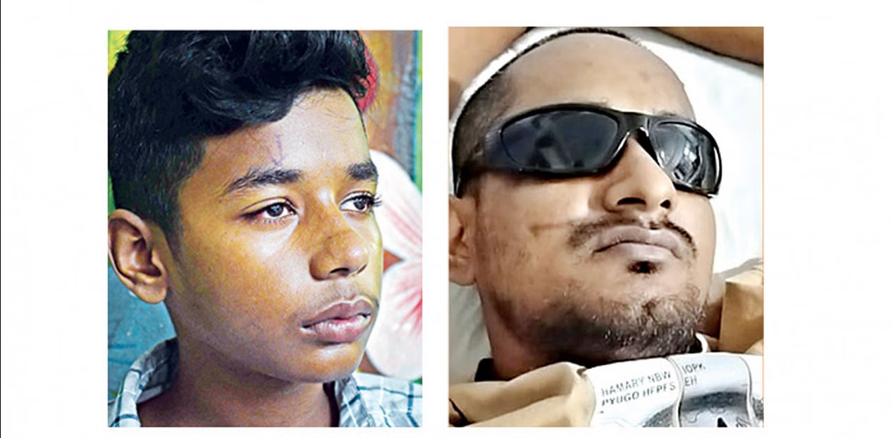 ছাত্র-জনতার আন্দোলনে অন্তত ৫৫০ জন এক চোখ, কিংবা দুই চোখই হারিয়েছেন