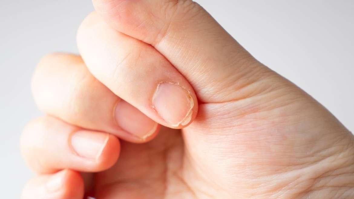 নখ ভেঙে যায় কেন, প্রতিরোধে কী করবেন