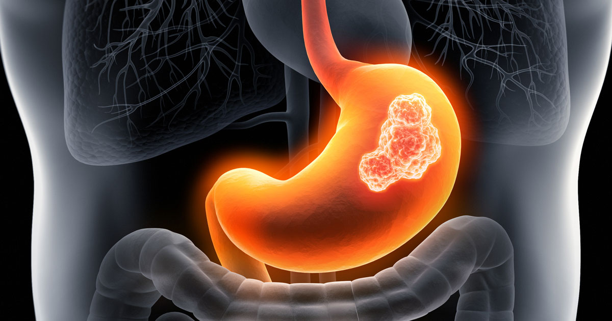 পাকস্থলীর ক্যানসার কেন হয়, লক্ষণ ও প্রতিরোধ