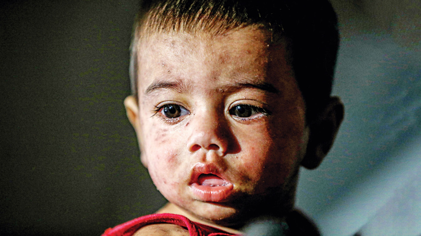 হামের প্রাদুর্ভাব