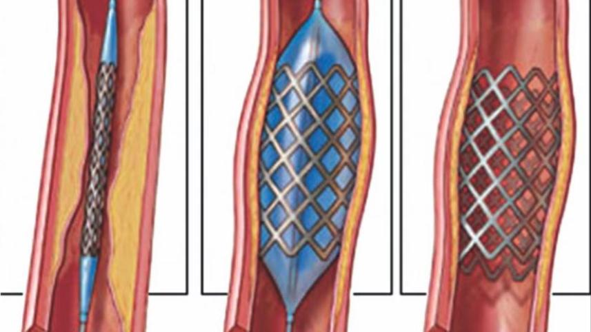 stent.jpg
