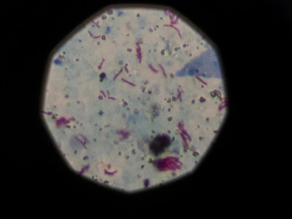 মালয়েশিয়ায় যক্ষ্মার প্রাদুর্ভাব, সতর্কতা জারি। ছবি: রয়টার্স