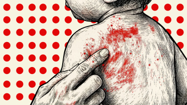 Measles