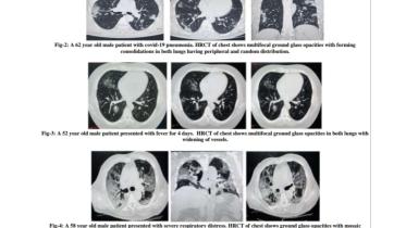 মৌলভীবাজার করোনা রোগী শনাক্তে আরটি পিসিআর এর চেয়ে সিটি স্ক্যান সংবেদনশীলতা বেশি pic.jpg