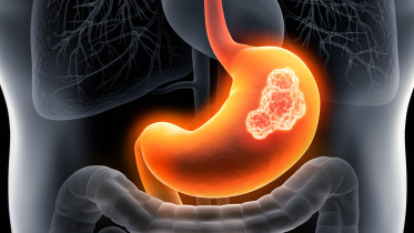 পাকস্থলীর ক্যানসার