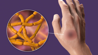 অ্যানথ্রাক্স রোগ, অ্যানথ্রাক্স সংক্রমণ, অ্যানথ্রাক্স প্রতিরোধ, অ্যানথ্রাক্স চিকিৎসা, অ্যানথ্রাক্স লক্ষণ, অ্যানথ্রাক্স ত্বক সংক্রমণ, অ্যানথ্রাক্স পরিপাকতন্ত্র, অ্যানথ্রাক্স শ্বাসজনিত, গবাদিপশুর অ্যানথ্রাক্স, অ্যানথ্রাক্স স্পোর, অ্যানথ্রাক্স টিকা, অ্যানথ্রা