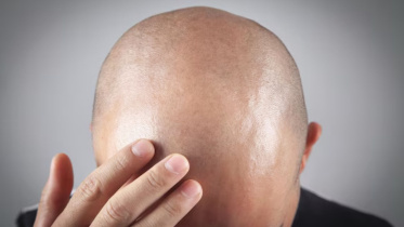 টাক মাথায় কি খুশকি হয়?