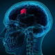 Brain Tumor
