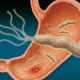 আলসার। প্রতীকী ছবি: সংগৃহীত